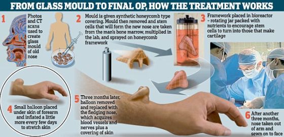 英國科學家在患者手臂上培育人造鼻子。如果一切順利進行，這個人造鼻子將從手臂上取下，而後移植到患者麵部