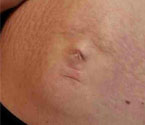 懷孕媽媽肚皮上驚現嬰兒臉