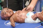 印度一男婴患人体自燃症