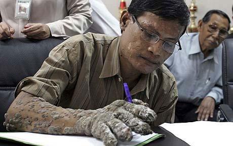 印尼 树人 手术后树皮复生 今后每年最少割两次