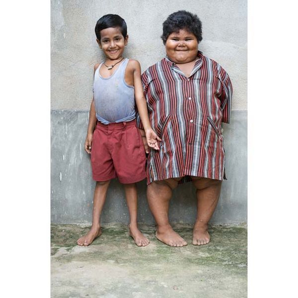 印度五岁小女孩身高1.1米体重76.2公斤